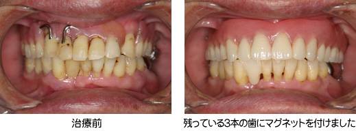 マグネット式義歯