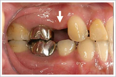 インプラント右 術前